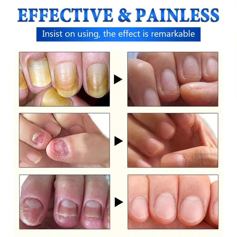 FungusGone - The Ultimate Solution for Healthy Nails!